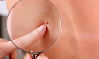 Коагулятор косметологический: особенности применения, где купить